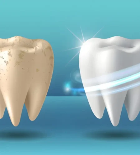Teeth Whitening Vs Professional Dental Cleaning Which One Should You Schedule First
